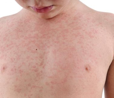 Trẻ Bị Dị Ứng Mẩn Đỏ Thì Nên Làm Gì?