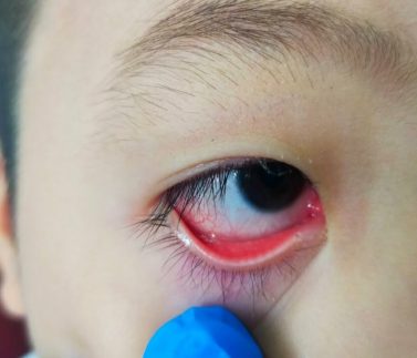 Trẻ Em Bị Đau Mắt Đỏ Có Đi Học Được Không?